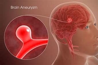 Cerebral-aneurysms