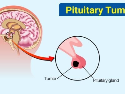 What is a Pituitary Tumor Is Pituitary Tumor Dangerous