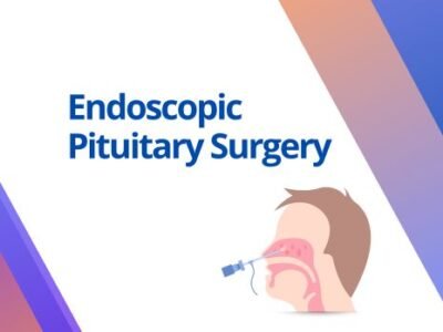 endoscopic-pituitary-surgery