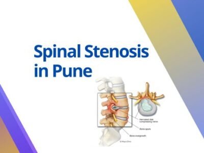 spinal stenosis