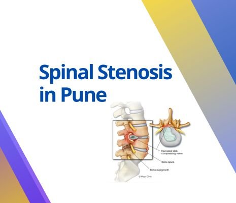 spinal stenosis