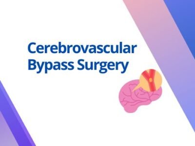 Cerebrovascular Bypass Surgery