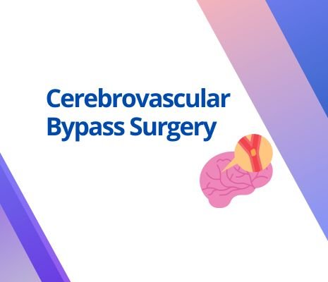 Cerebrovascular Bypass Surgery