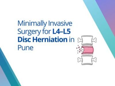 L4–L5 Disc Herniation