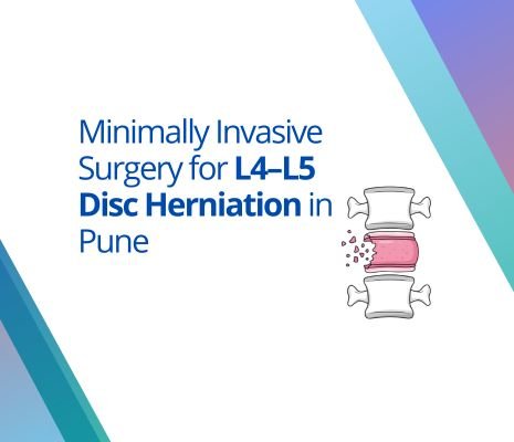 L4–L5 Disc Herniation