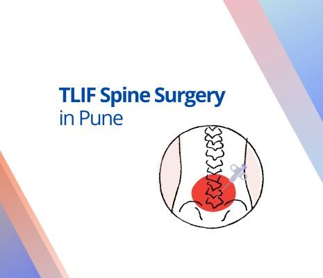 tlif spine surgery