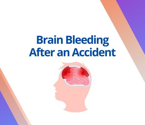 Brain Bleeding After an Accident