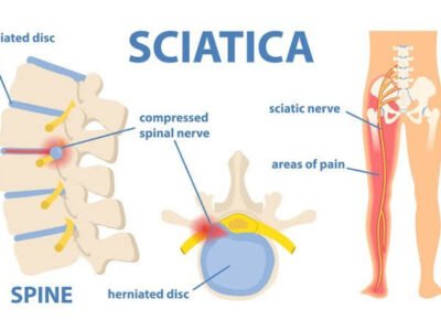 Symptoms of pinched nerve in lower back