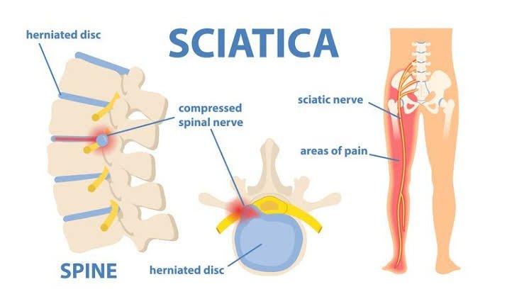 Symptoms of pinched nerve in lower back
