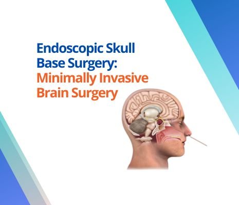 Endoscopic Skull Base Surgery: Minimally Invasive Brain Surgery