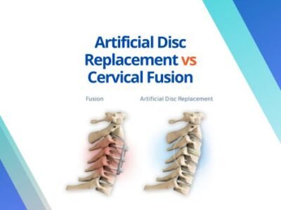Artificial Disc Replacement vs Cervical Fusion