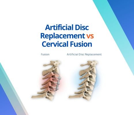 Artificial Disc Replacement vs Cervical Fusion