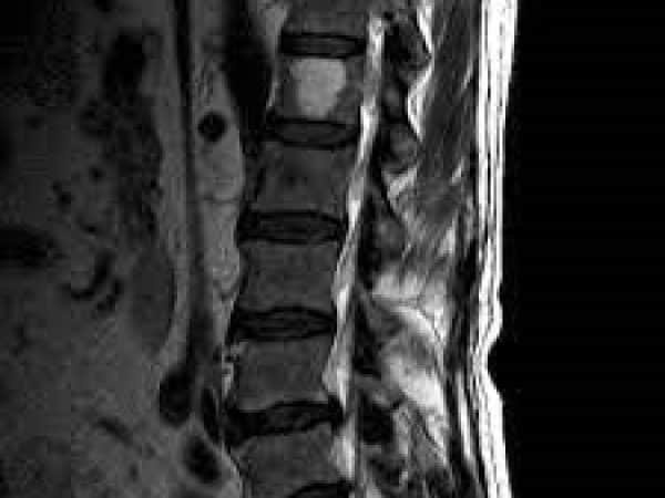 Spine-Tumors2