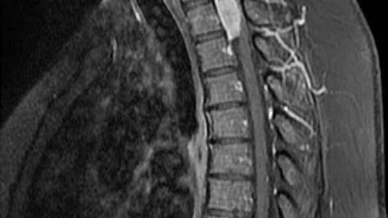 Thoracic-spine-Meningioma